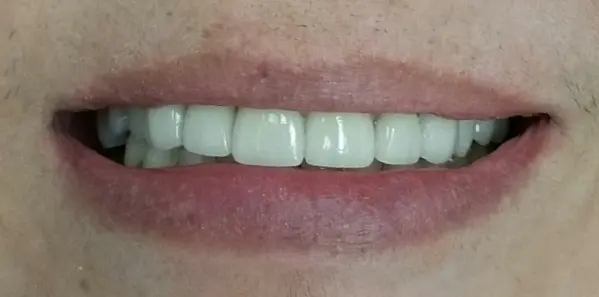 Anterior Fixed Bridge — after