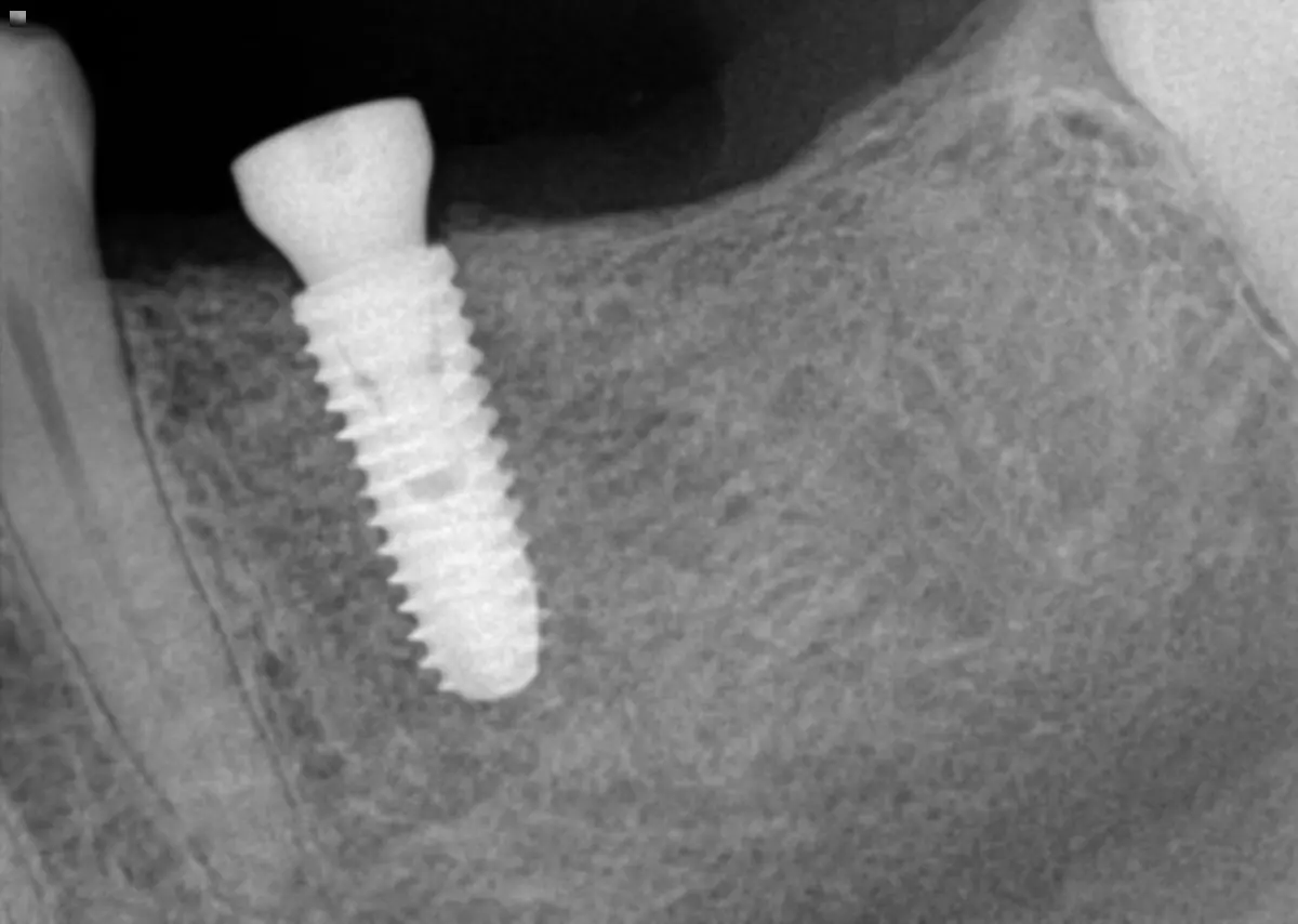 Single Implant & Crown — after
