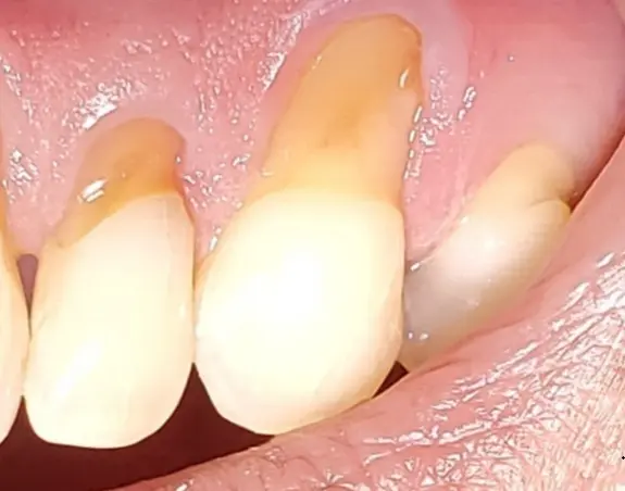 Anterior Composite Fillings — before