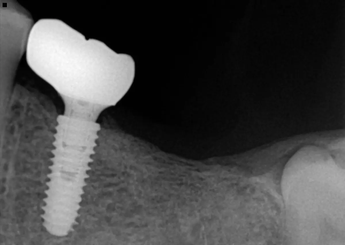 Single Implant & Crown — after view 2
