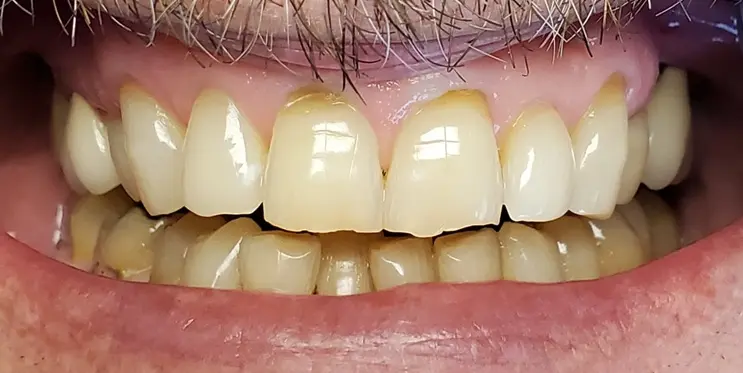 Full Porcelain Veneers — before