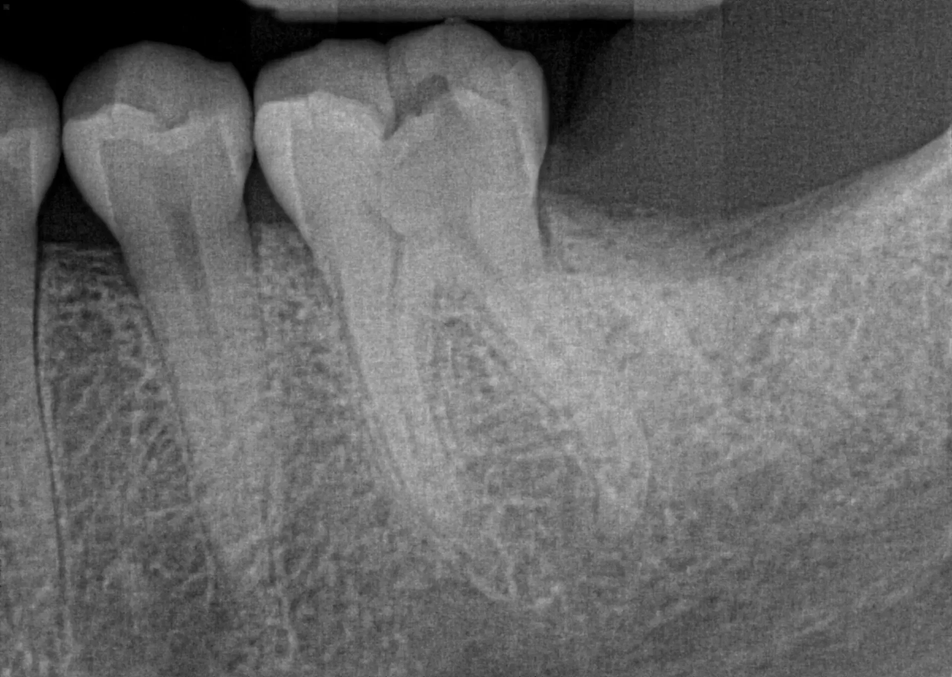 Molar Endodontic Treatment — before