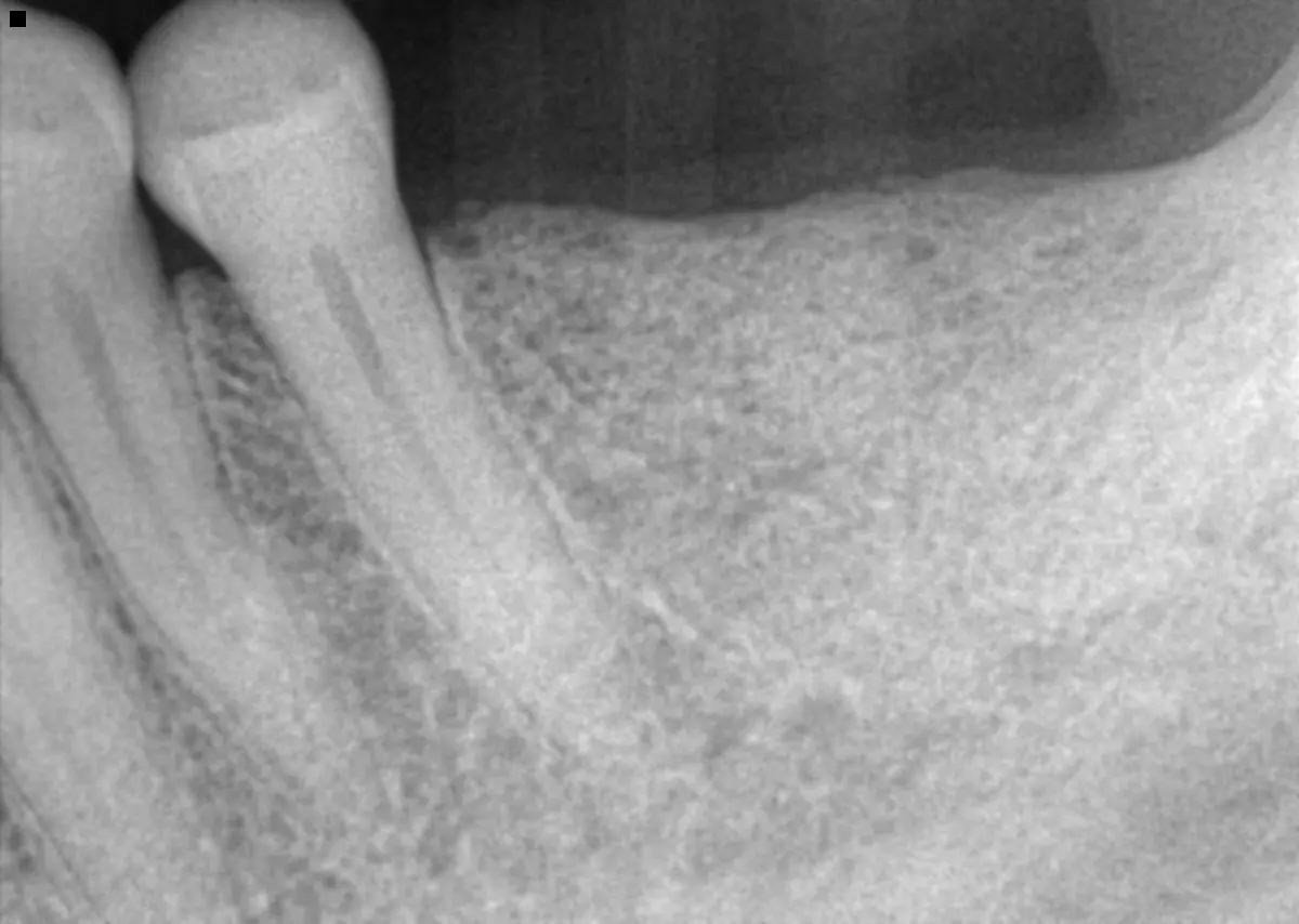 Single Implant & Crown — before
