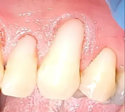 Anterior Composite Fillings — after