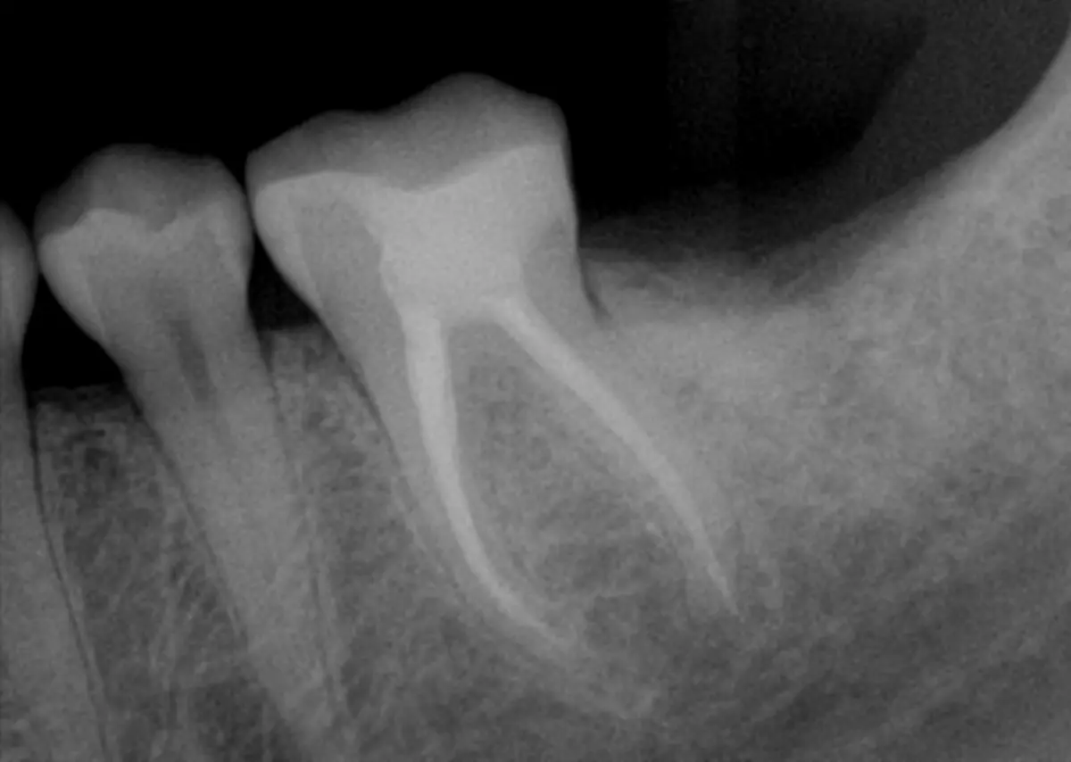 Molar Endodontic Treatment — after