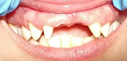 Anterior Fixed Bridge — before
