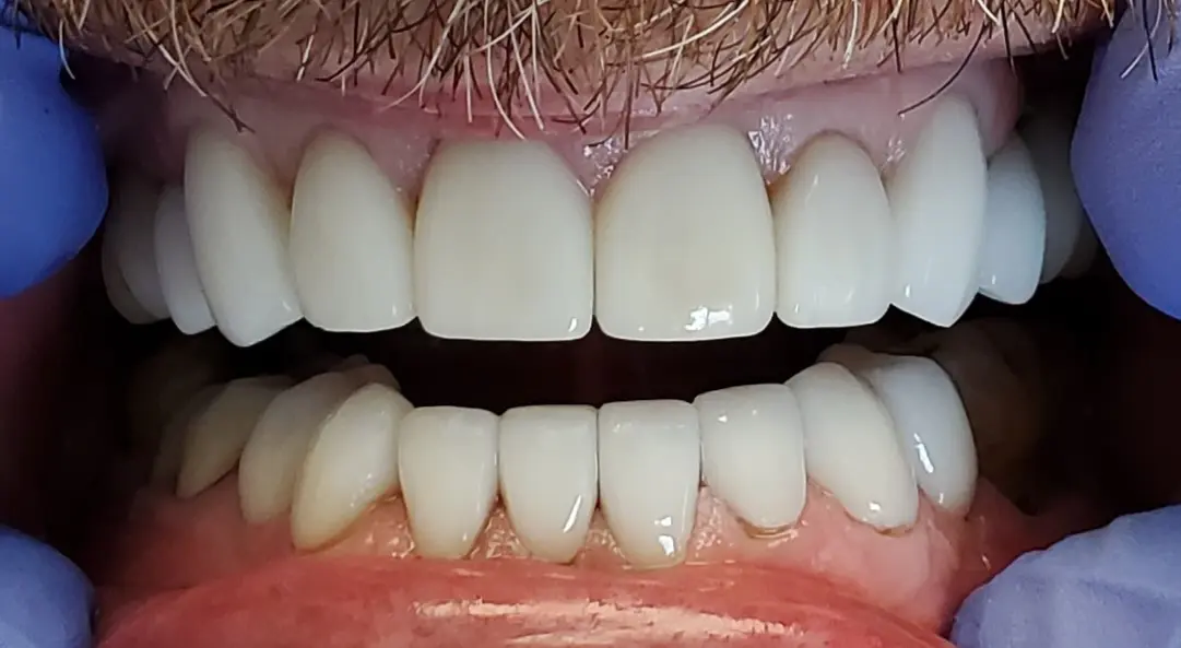 Full Porcelain Veneers — after